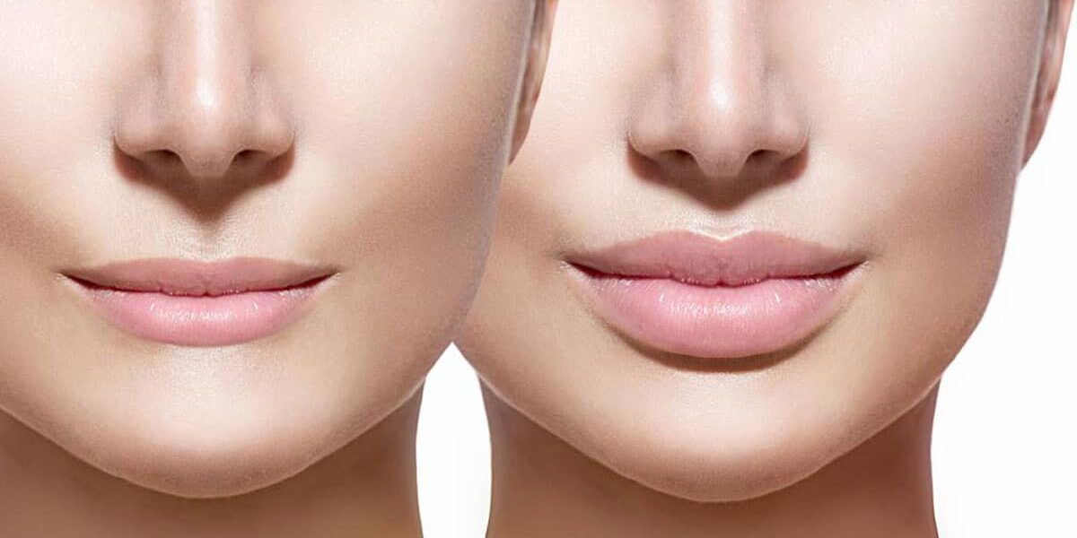 Lip Reducation Surgery