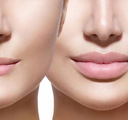 Lip Reducation Surgery